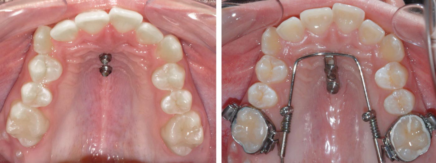 Aparat ortodontyczny umieszczony wzdłuż łuku zębowego